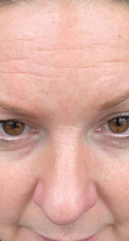 Retinova™ Vita-A Retinal Tightening Booster