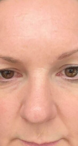 Retinova™ Vita-A Retinal Tightening Booster